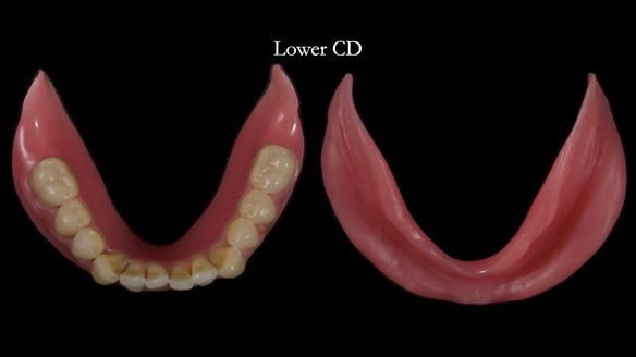 Newsletter 83: Sheila’s Complete Denture Success