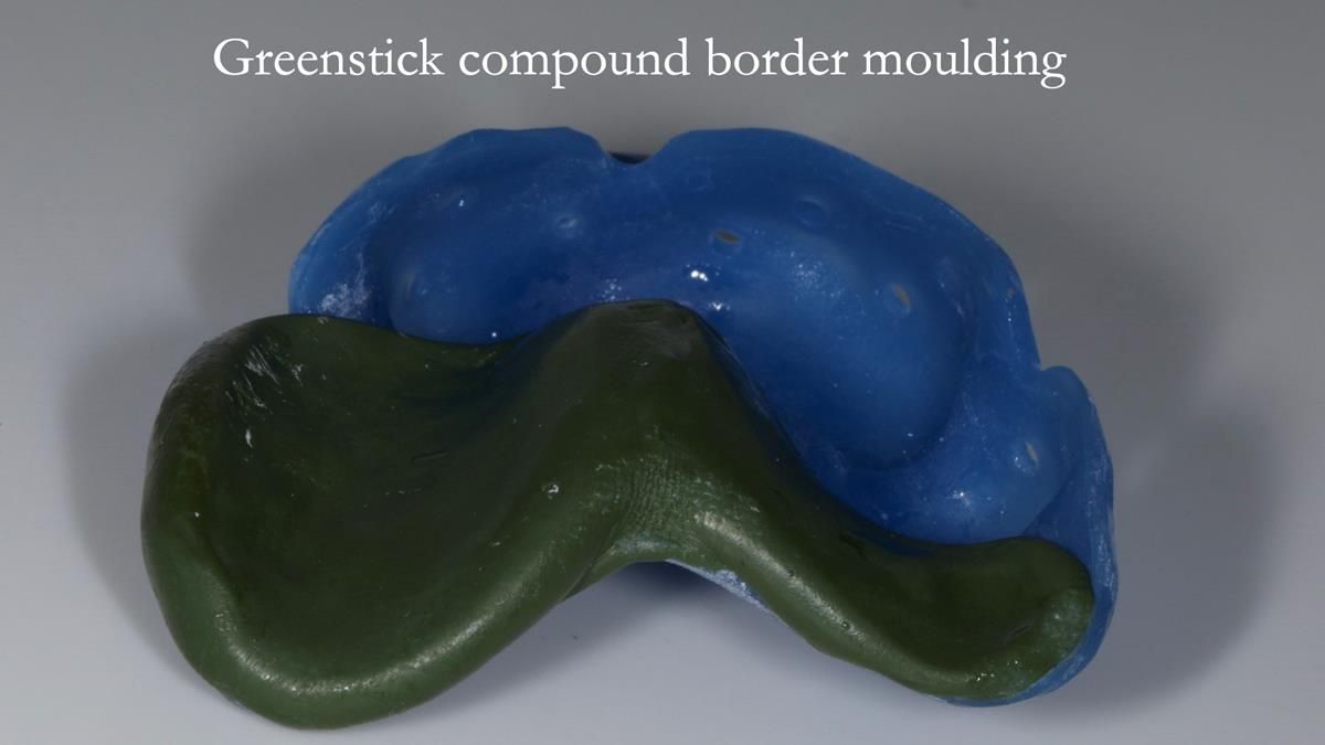 Newsletter 89 – Simon: A Challenging Kennedy Class II Division 1 Upper CoCr Partial Denture with a High Smile Line