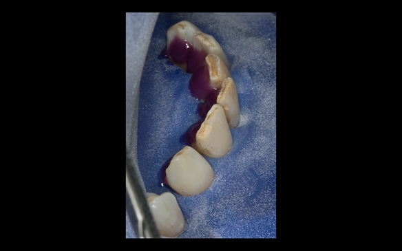 Figure 66 Etching the lingual of the lower anterior teeth prior to provision of composite rest seats to assist in stabilising and supporting the metal based lower denture