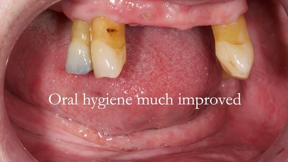 Finlay's Newsletter 59 Ultra hard partial dentures made for Gill