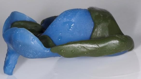 Newsletter 77: Jeremy’s case – immediate complete upper denture