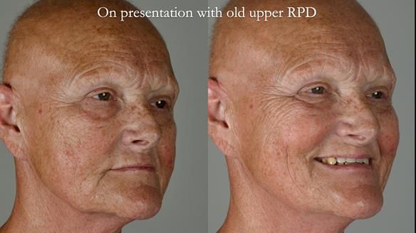 Newsletter 81 - Pam’s Story — how a partial denture changed her life (+ live walkthrough this Thursday)