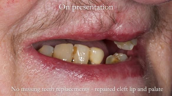 Newsletter 55 Provision of metal based partial dentures for Zephyrine with a repaired cleft lip and palate