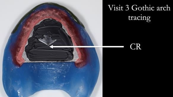 Newsletter 53 showing the making and fitting of ultra life-like dentures for Valena