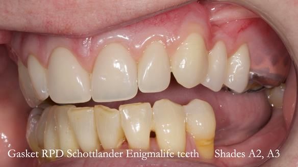 Finlay's Newsletter 58 Gasket upper partial denture for Zoe