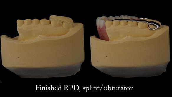 Upper metal base partial denture/occlusal stabilisation splint/obturator - full protocol