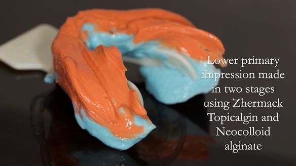 Managing poor implant positioning with complete dentures and Locator attachments - full protocol Newsletter 41