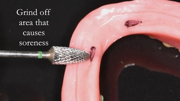 Newsletter 75: Marion’s case - Step-by-step complete denture workflow