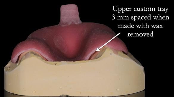 Newsletter 50 Special edition Complete Dentures FULL PROTOCOL