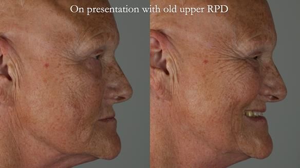 Newsletter 81 - Pam’s Story — how a partial denture changed her life (+ live walkthrough this Thursday)