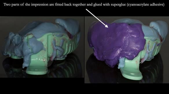Finlay's Case Study Newsletter 40 - Immediate Mk 1 RPD to Definitive Mk 2 RPD - full protocol