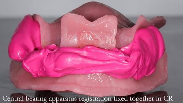 Finlay's Newsletter 59 Ultra hard partial dentures made for Gill