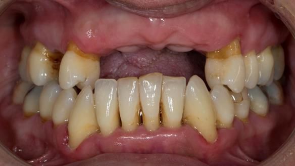 Finlay's Newsletter 63 Case study provision of metal based Scandinavian RPD - functional 10 years on