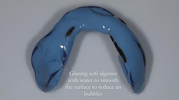 Newsletter 82 Mary - A complete upper and a one-tooth gasket denture