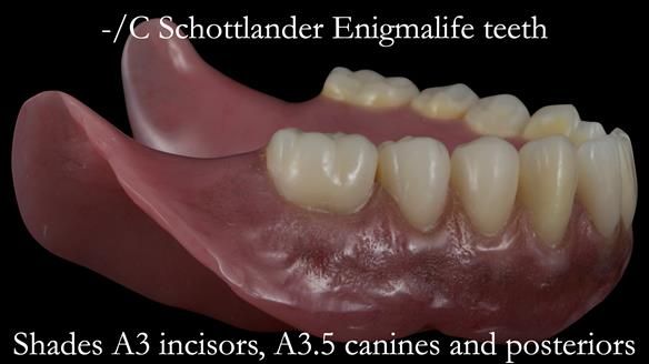 Newsletter 53 showing the making and fitting of ultra life-like dentures for Valena