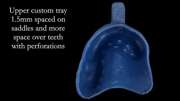 Finlay's Newsletter 64 case study - provision of a Kennedy class 2 metal based Scandinavian RPD for Ian