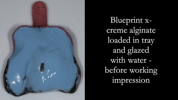 Finlay's Newsletter 59 Ultra hard partial dentures made for Gill