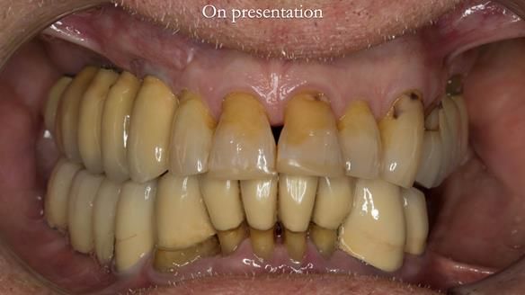 Ken – going downhill, first class