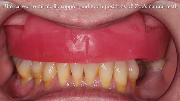Finlay's Newsletter 58 Gasket upper partial denture for Zoe