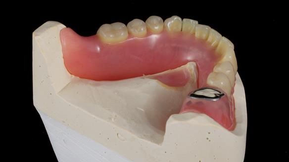 Newsletter 82 Mary - A complete upper and a one-tooth gasket denture
