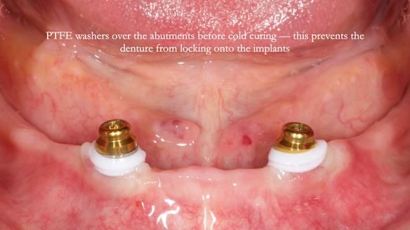 Newsletter 78: What do Clark Gable and a Locator® overdenture have in common?