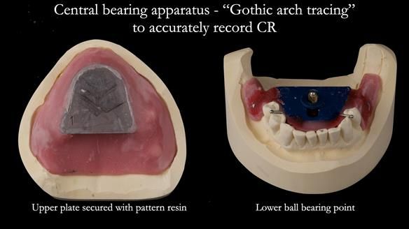 Solving Linda’s Failed “All on 4” implant bridges - full protocol Newsletter 42