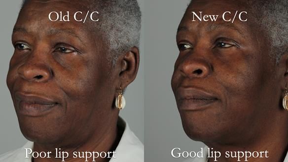 Newsletter 53 showing the making and fitting of ultra life-like dentures for Valena