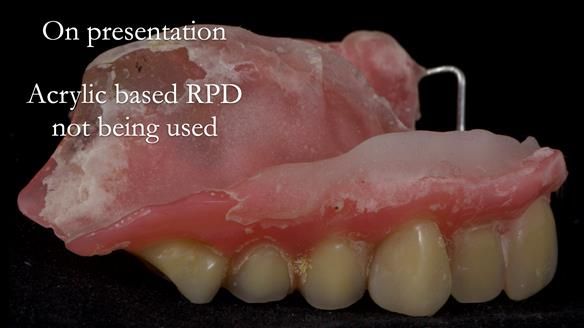 Newsletter 55 Provision of metal based partial dentures for Zephyrine with a repaired cleft lip and palate