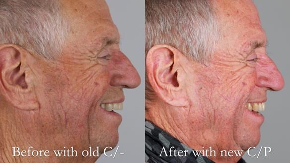 Newsletter 54 case presentation upper complete denture and lower Scandinavian designed hygienic partial denture for David