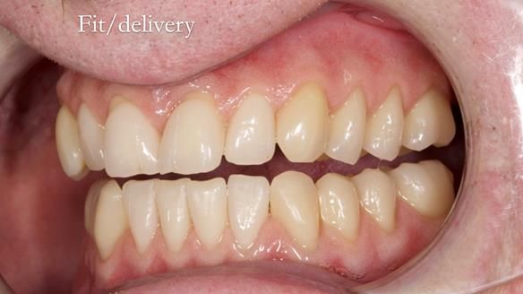 Newsletter 57 showcases the making and fitting process of implant-supported complete dentures for Alisdair