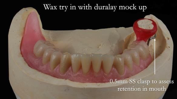 Finlay's Newsletter 59 Ultra hard partial dentures made for Gill
