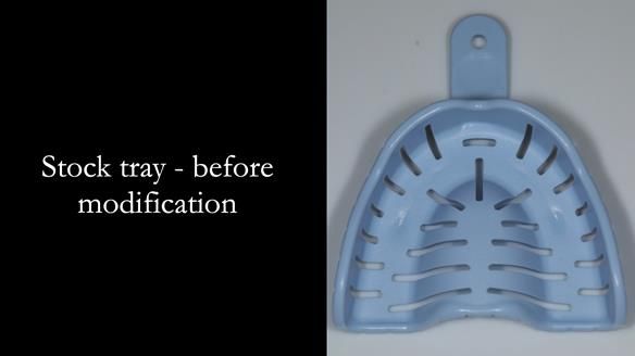 Newsletter 56 showing the making and fitting of a bilateral free end saddle upper removable partial denture (RPD) for patient with pemphigus