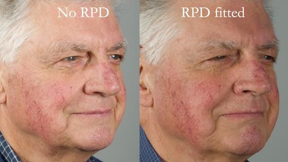 Finlay's Newsletter 64 case study - provision of a Kennedy class 2 metal based Scandinavian RPD for Ian