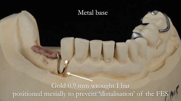 Finlay's Newsletter 61 provision of a lower unilateral free end saddle metal based partial denture for Joyce