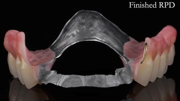 Finlay's Newsletter 60 Sylvia's upper Kennedy Class 2 Mod 1 metal based upper RPD