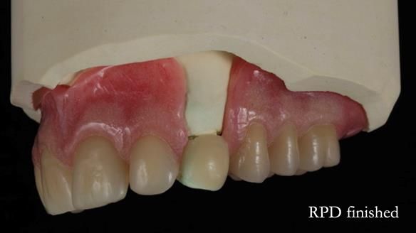 Newsletter 55 Provision of metal based partial dentures for Zephyrine with a repaired cleft lip and palate