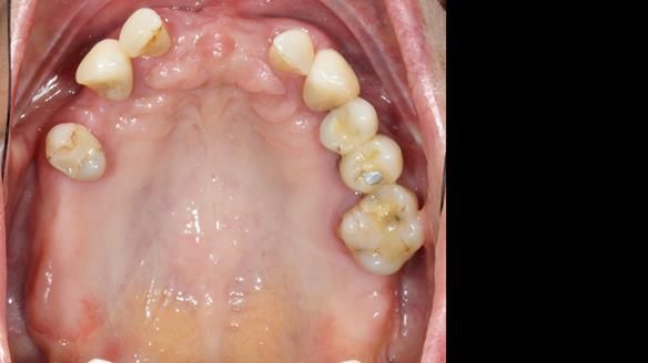 Newsletter 81 - Pam’s Story — how a partial denture changed her life (+ live walkthrough this Thursday)