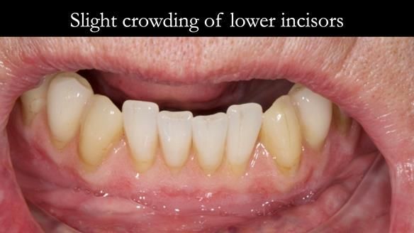 Newsletter 50 Special edition Complete Dentures FULL PROTOCOL