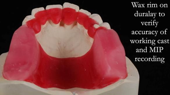 Newsletter 56 showing the making and fitting of a bilateral free end saddle upper removable partial denture (RPD) for patient with pemphigus