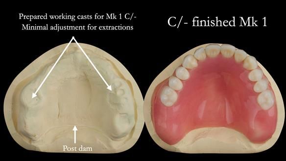 Newsletter 52 Managing Jo’s failing dentition with extractions and Mk 1/Mk 2 complete upper dentures and lower partial dentures FULL PROTOCOL