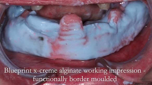 Finlay's Newsletter 59 Ultra hard partial dentures made for Gill
