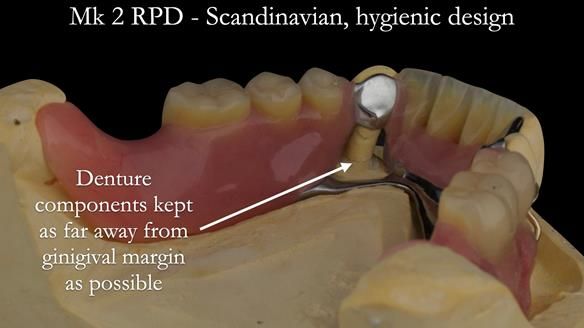 Finlay's Case Study Newsletter 40 - Immediate Mk 1 RPD to Definitive Mk 2 RPD - full protocol