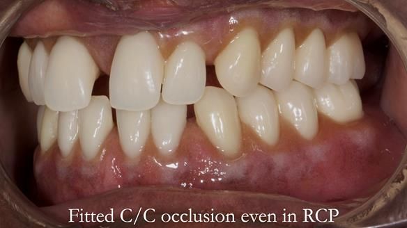 Newsletter 53 showing the making and fitting of ultra life-like dentures for Valena