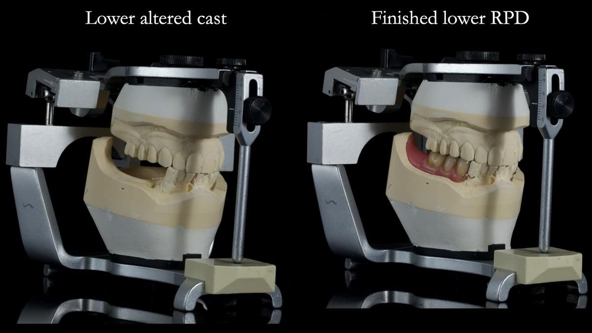 Newsletter 87 – Father Peter: A Partial Denture that needed Minor Miracle