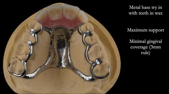 Finlay's Newsletter 63 Case study provision of metal based Scandinavian RPD - functional 10 years on