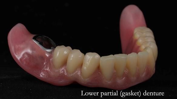 Newsletter 82 Mary - A complete upper and a one-tooth gasket denture
