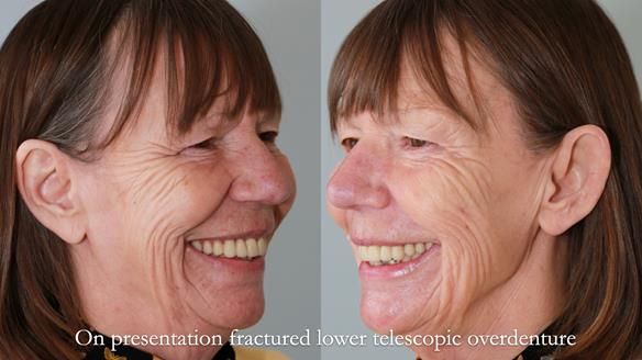 Newsletter 76: Jackie’s case – Telescopic overdenture & precision RPD (the tricky truth!)