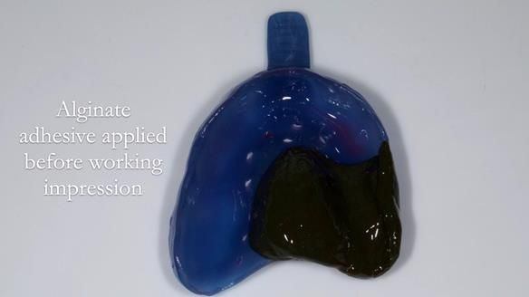 Finlay's Newsletter 64 case study - provision of a Kennedy class 2 metal based Scandinavian RPD for Ian