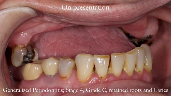 Newsletter 52 Managing Jo’s failing dentition with extractions and Mk 1/Mk 2 complete upper dentures and lower partial dentures FULL PROTOCOL