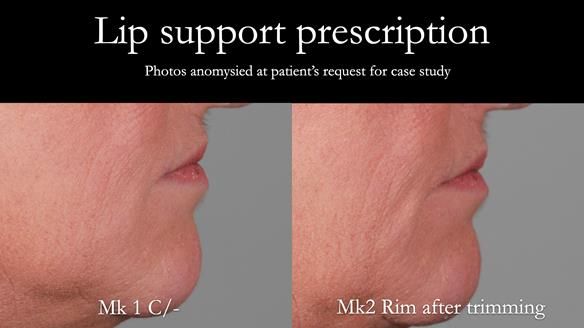 Newsletter 52 Managing Jo’s failing dentition with extractions and Mk 1/Mk 2 complete upper dentures and lower partial dentures FULL PROTOCOL